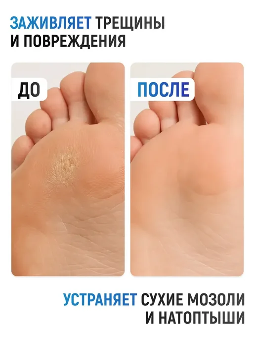 COSMEDICAL Кератолитик для пяток, вариант, фото 5