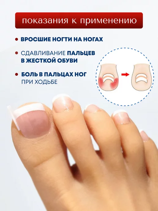 MyBalance Вставка от вросшего ногтя, белый, фото 2